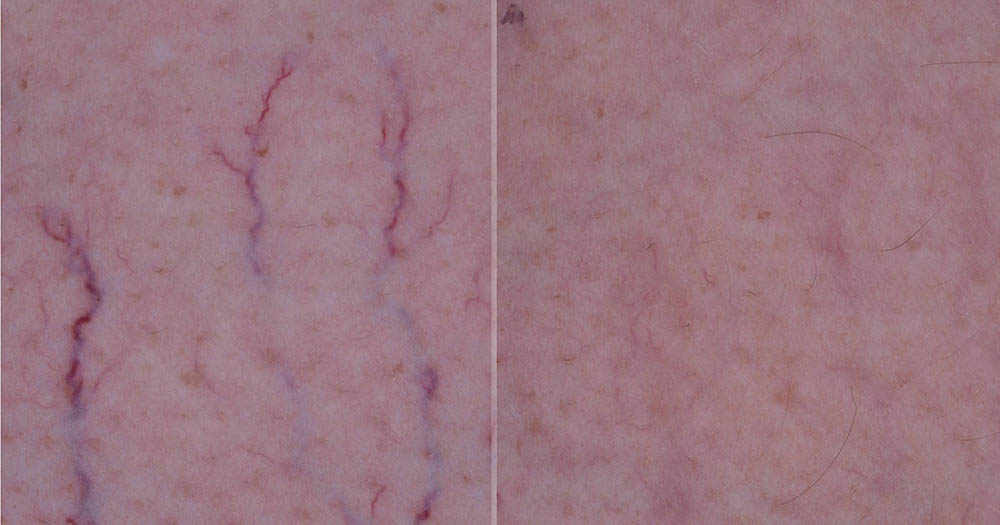 1064_Vascular_12