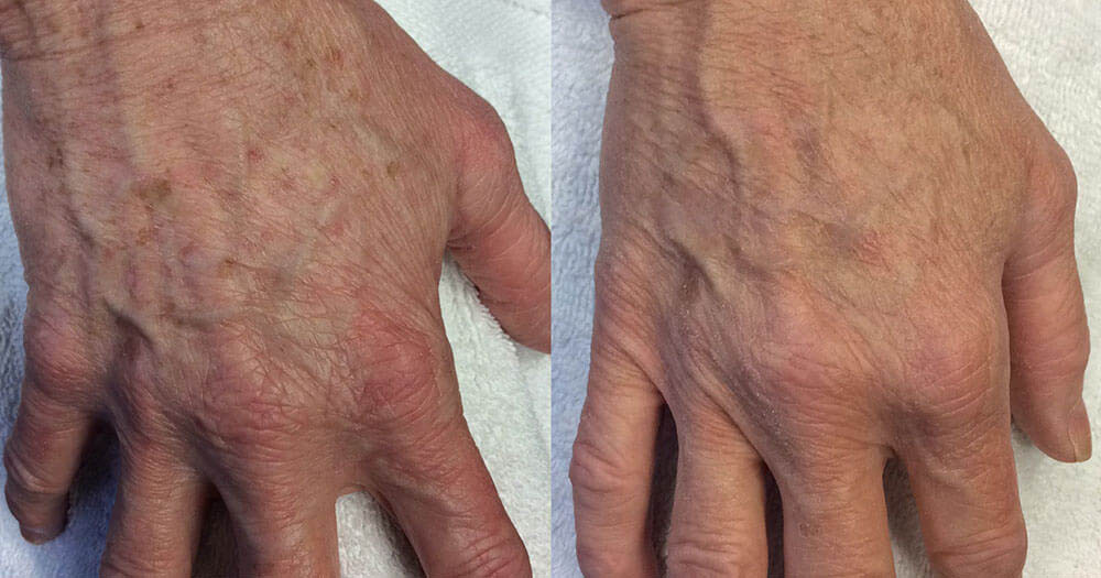 Excel-V-Aggarwal-MD-BA-hands-veins